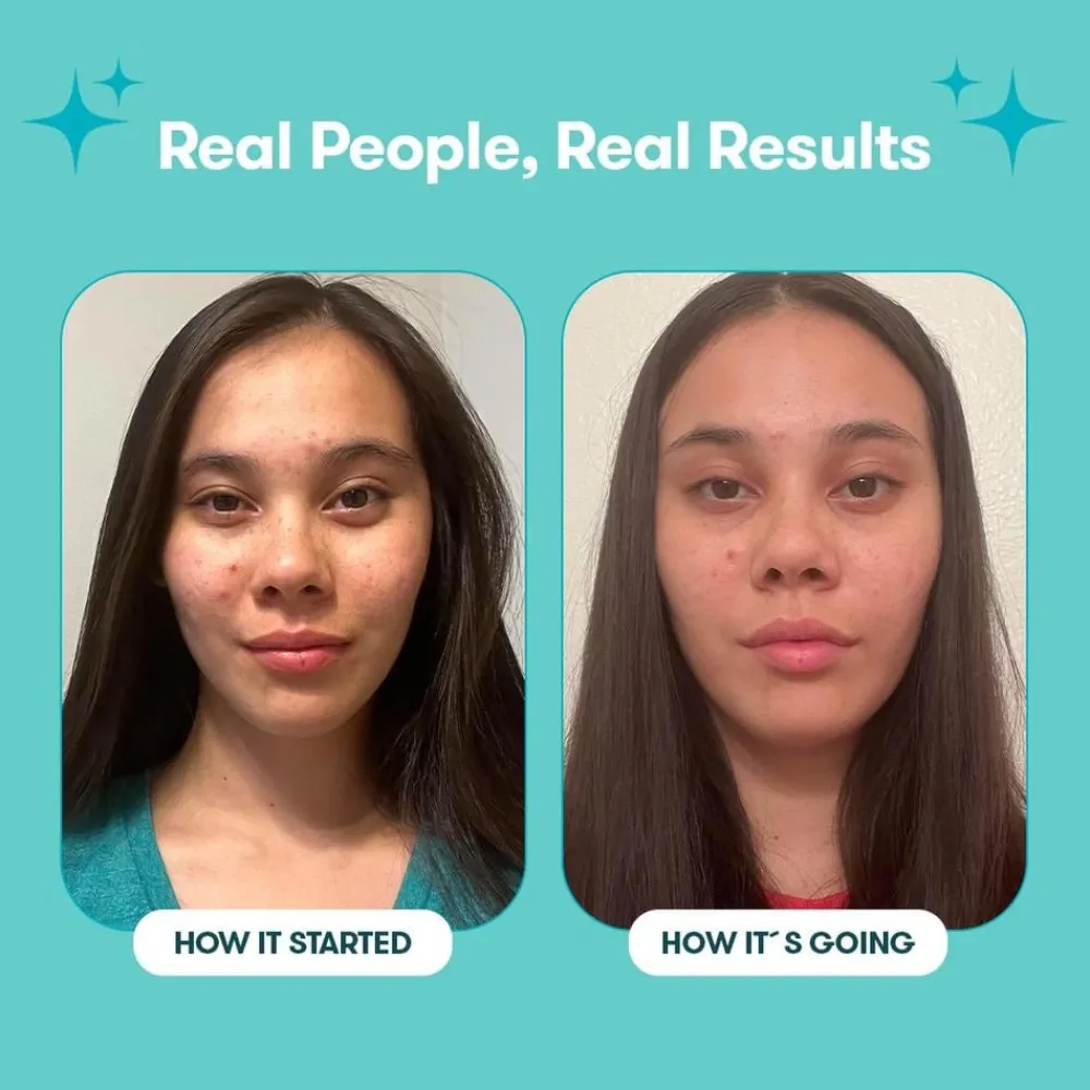 Proactiv Körperpflege & Hygiene|Kosmetik-Gentle 30 Tage Routine 120 ml + 30 Zits Happen Patches