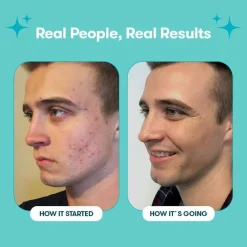 Proactiv Körperpflege & Hygiene|Kosmetik-Solution 60 Tage Routine 300 ml + 30 Zits Happen Patches